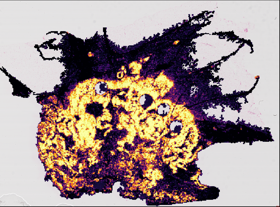Heatmap of breast cancer detection