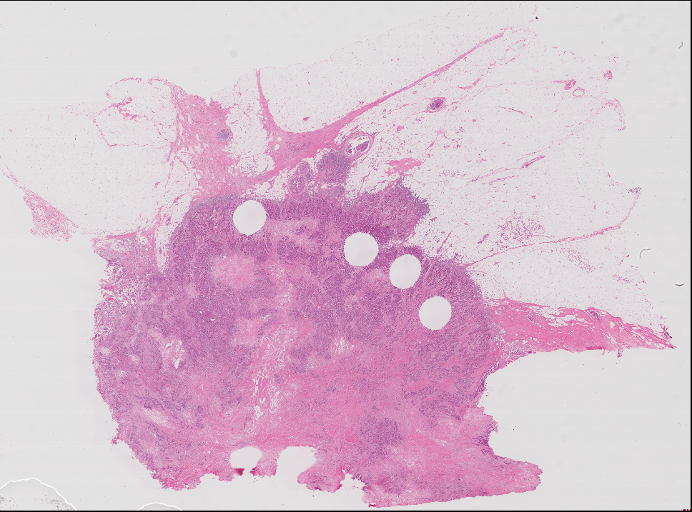 TCGA BRCA sample slide